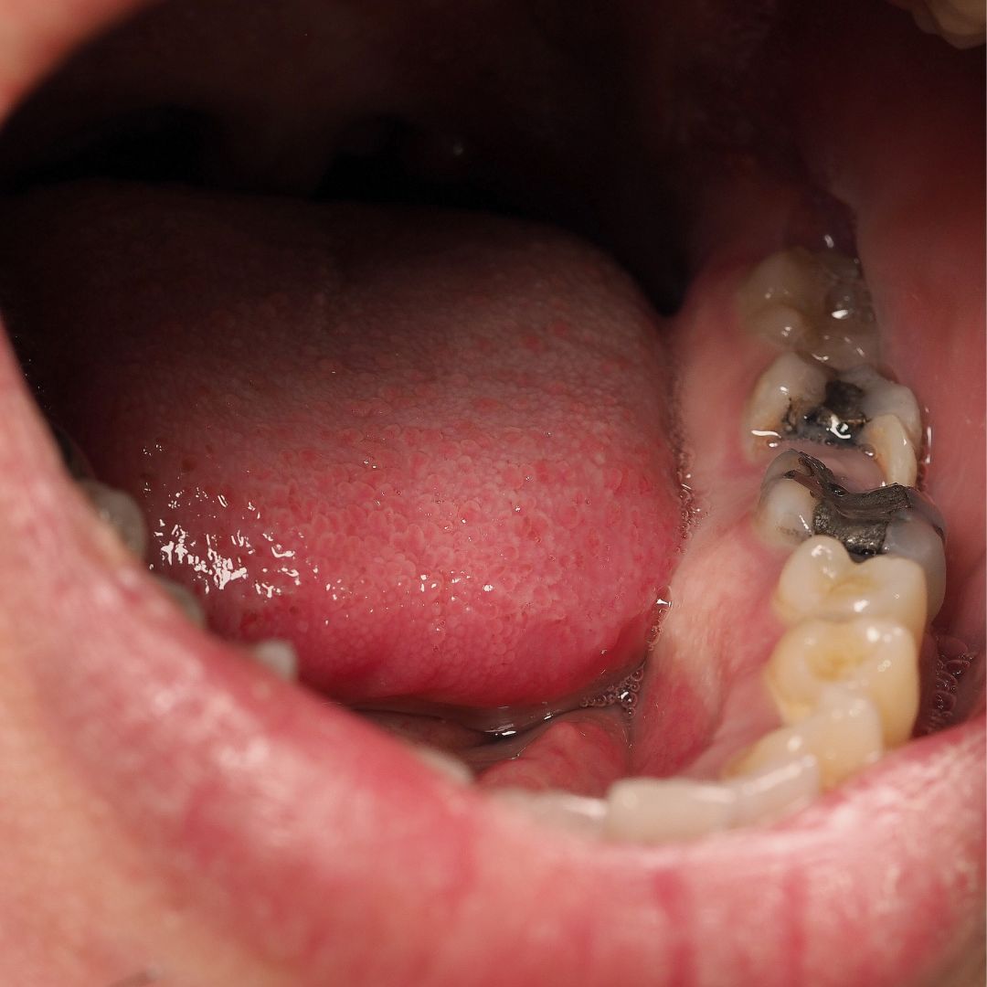 Root Canal