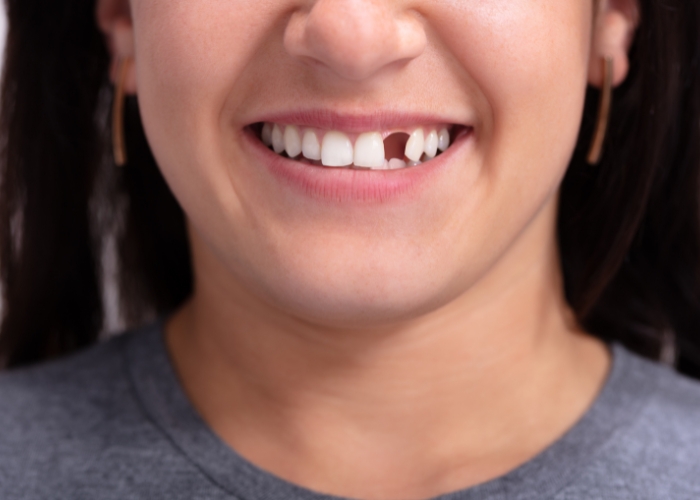 Replace missing teeth with dental implants in Rosenberg